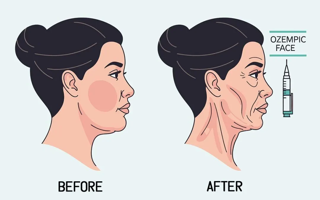 stars with ozempic face