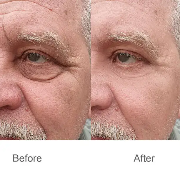 what is ozempic face before and after pictures