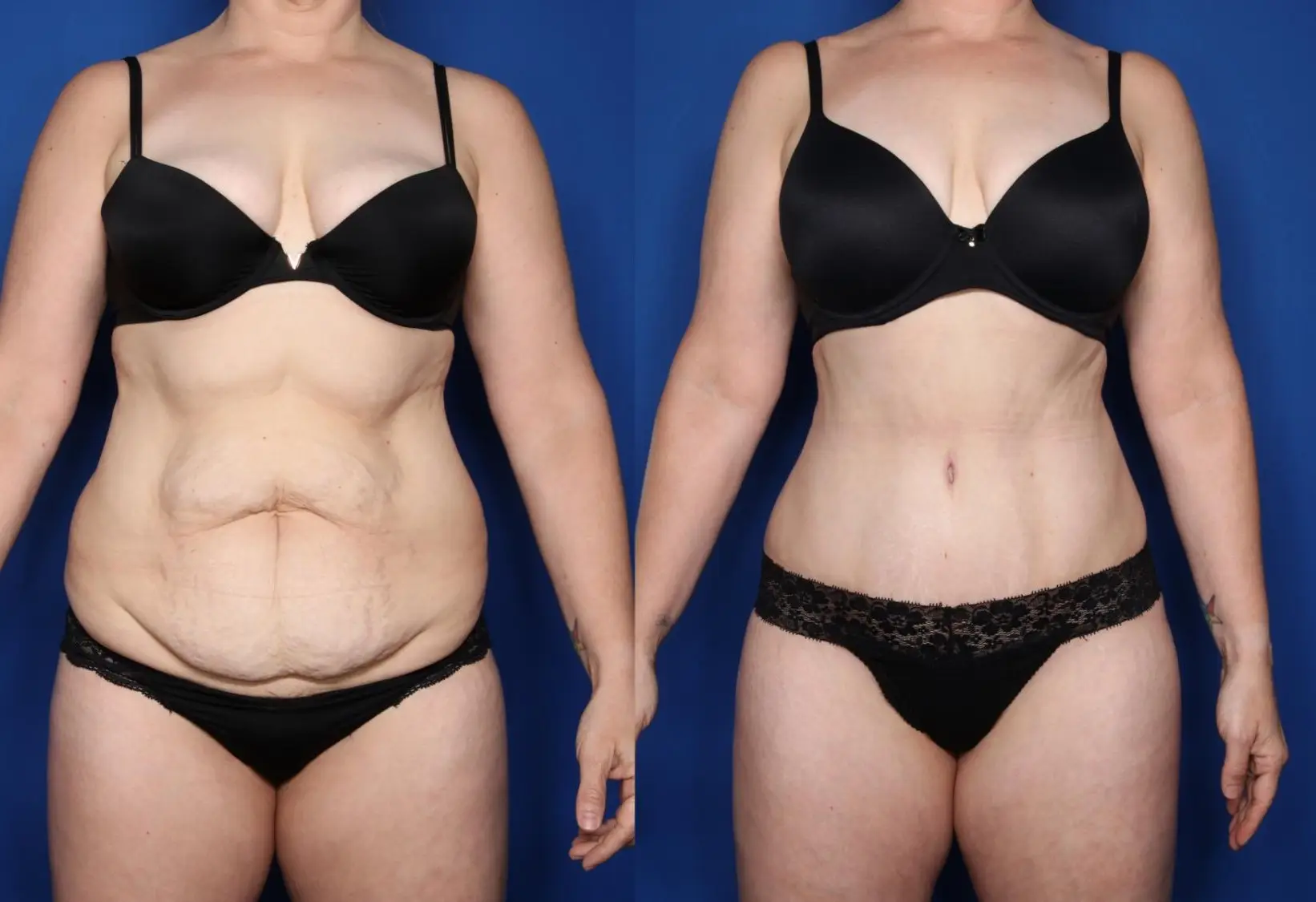 apron belly after weight loss