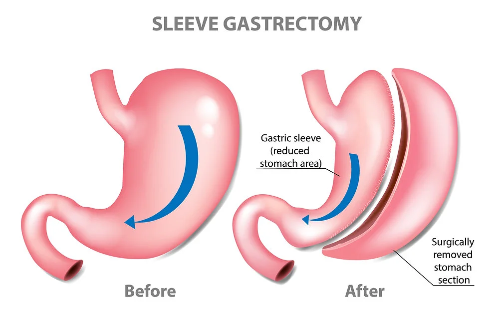 weight loss surgery before and after