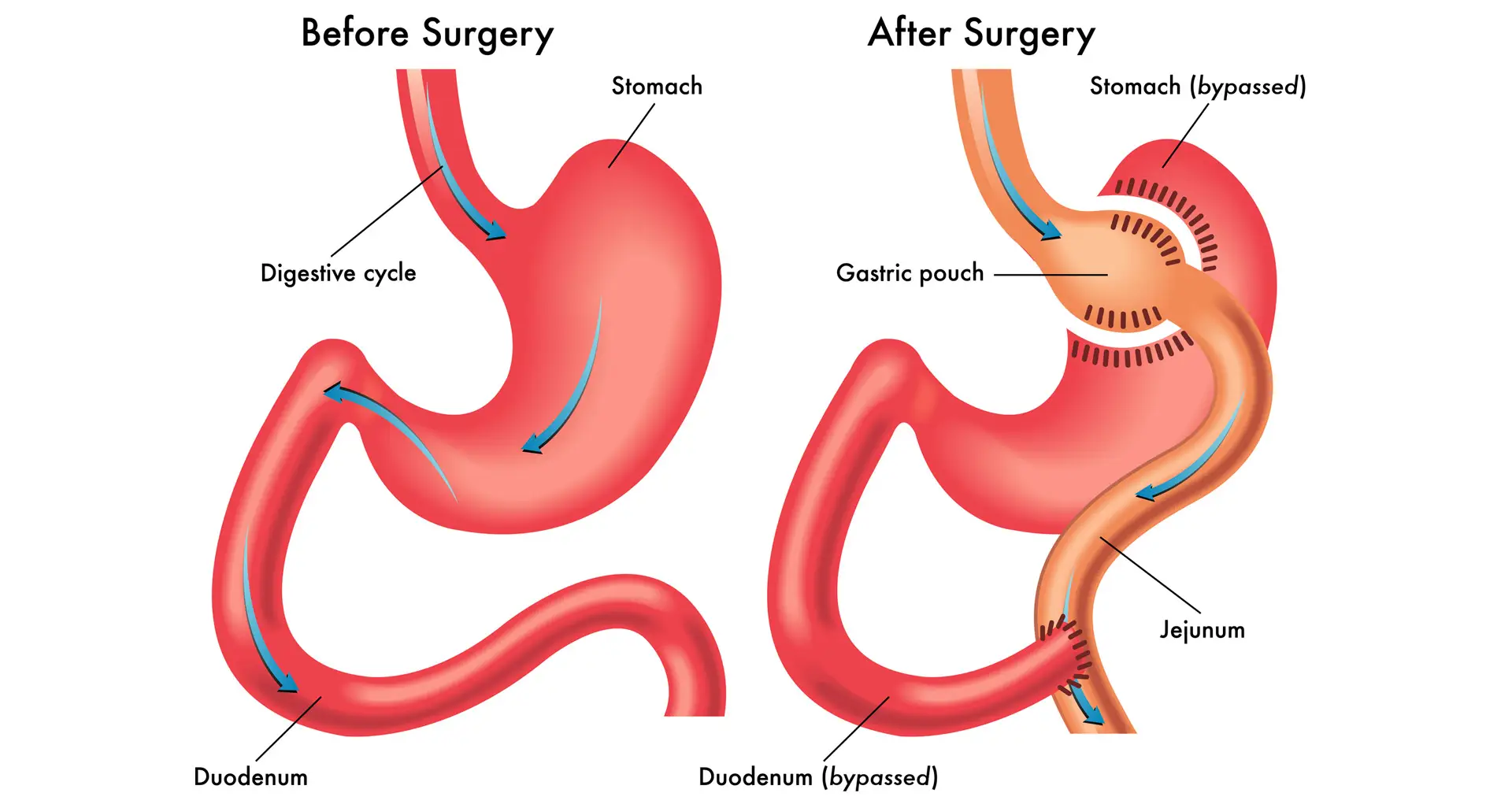 weight loss surgery before and after