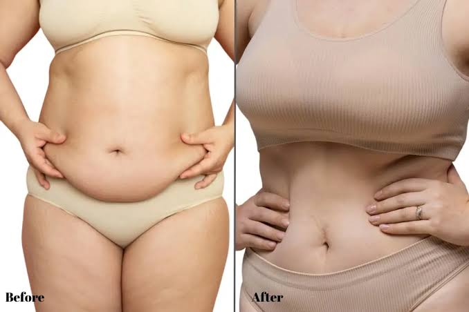 apron belly after weight loss