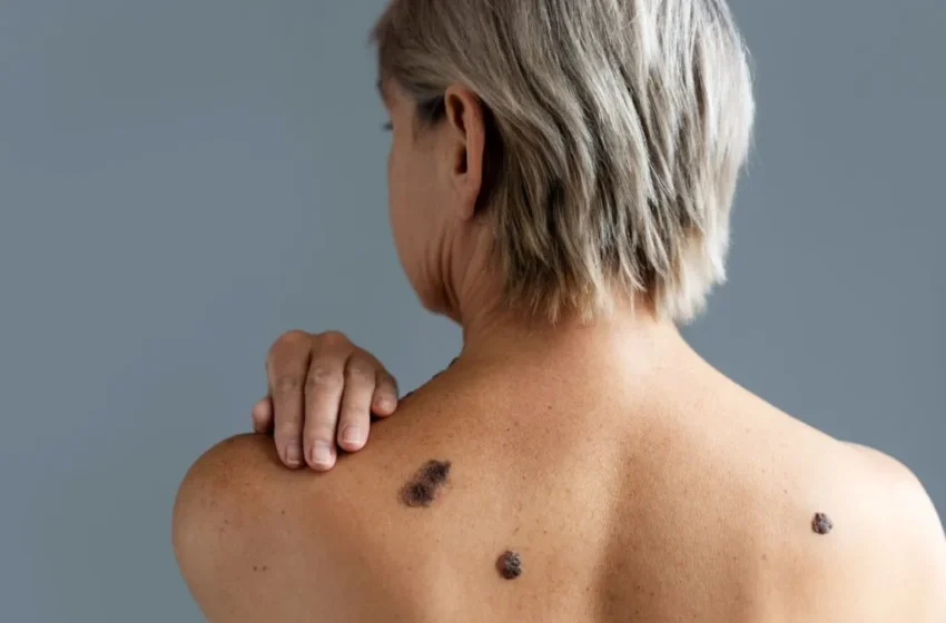  How to Perform Skin Self-Exams for Melanoma Early Detection