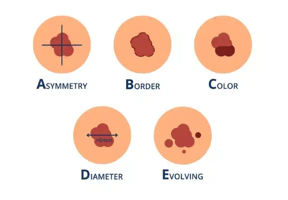 symptoms of melanoma