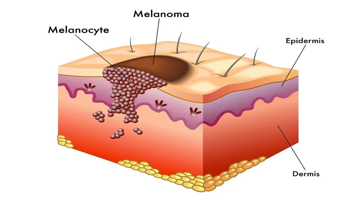 melanoma