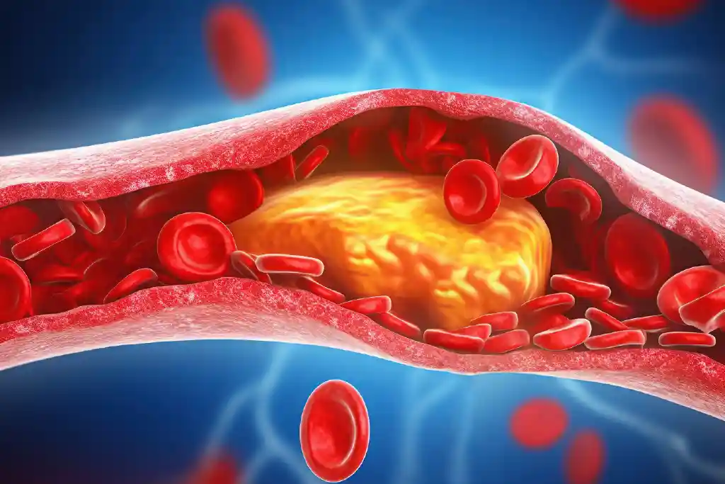 symptoms of high bad cholesterol