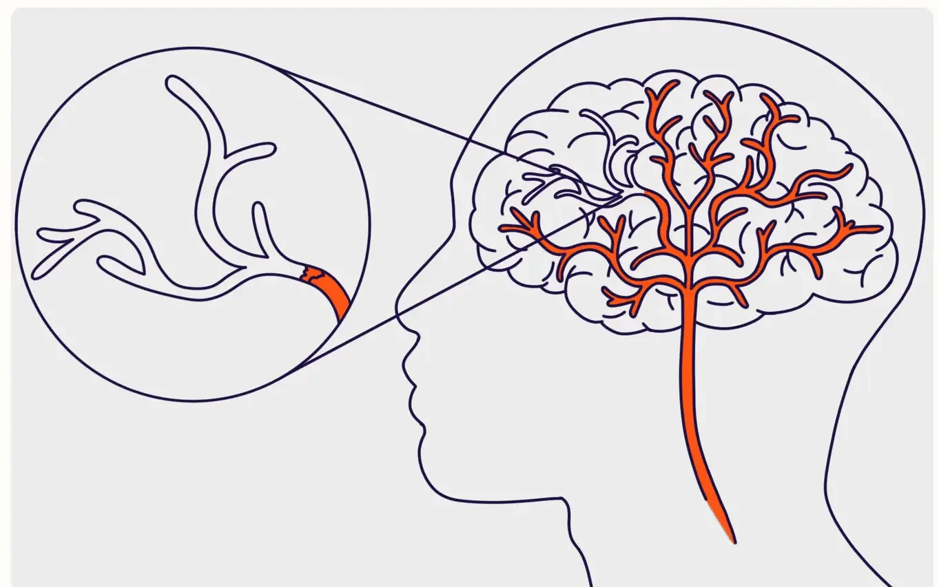 symptoms of high cholesterol dizziness