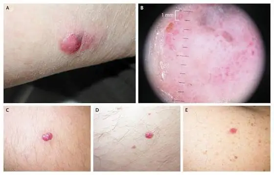 symptoms of melanoma
