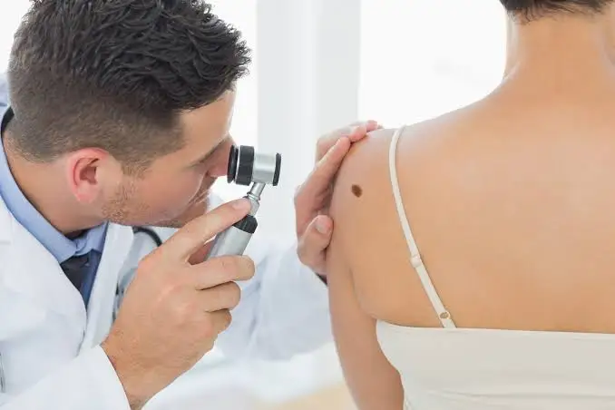 symptoms of melanoma