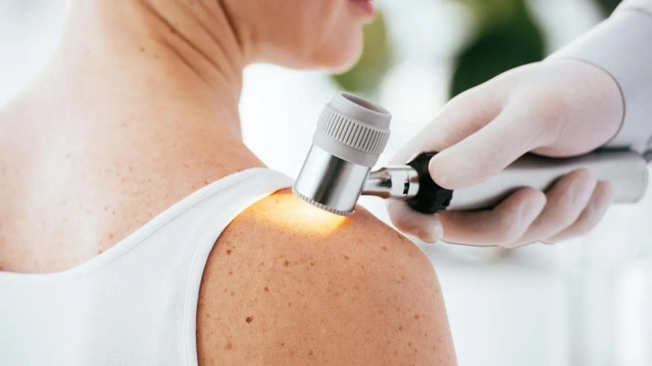 melanoma