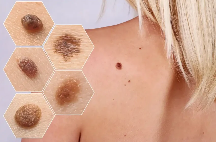  Preventing Advanced Melanoma Through Early Stage Detection