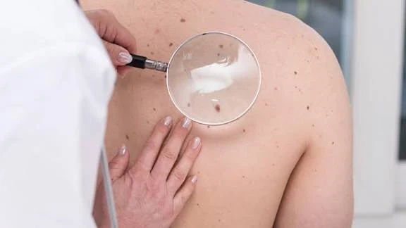 malignant melanoma