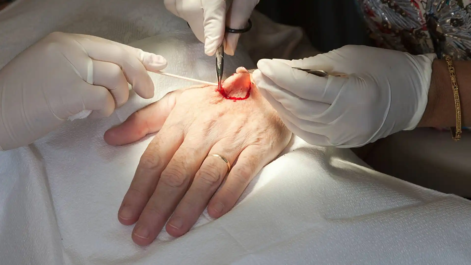 malignant melanoma