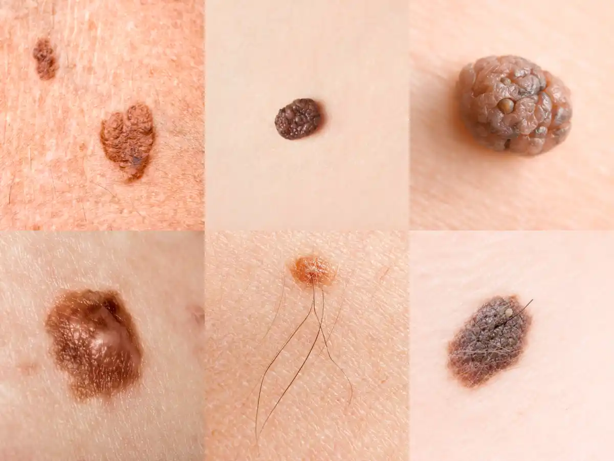 malignant melanoma