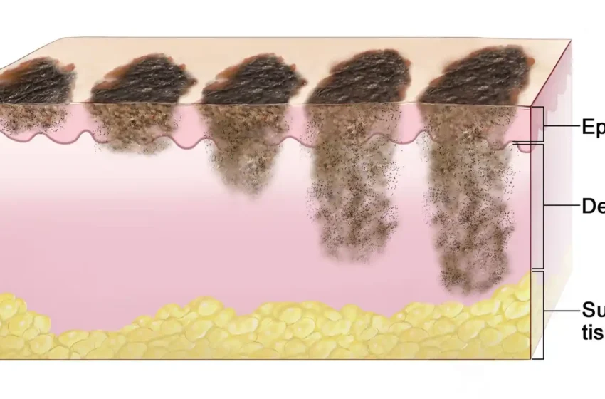  How Fast Does Melanoma Spread? Risks of Delayed Diagnosis