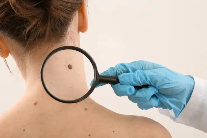 how fast does melanoma spread