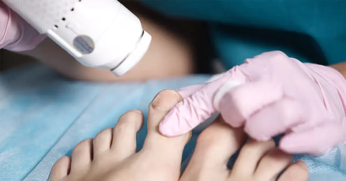 Melanoma Under Toenail
