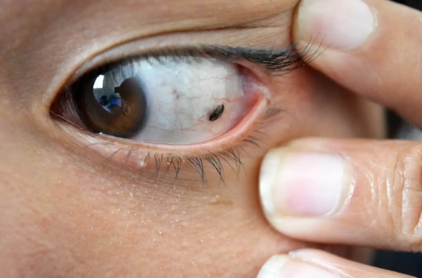 eye melanoma