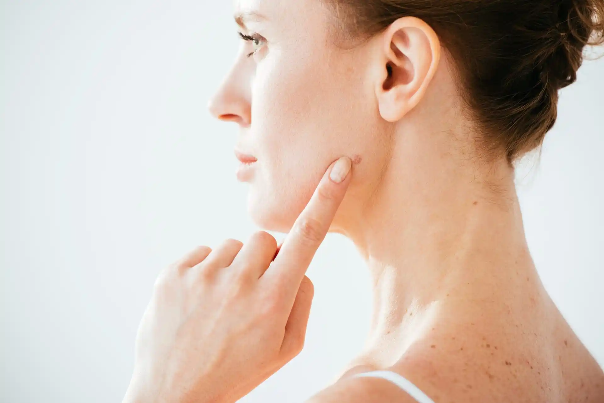melanoma on face