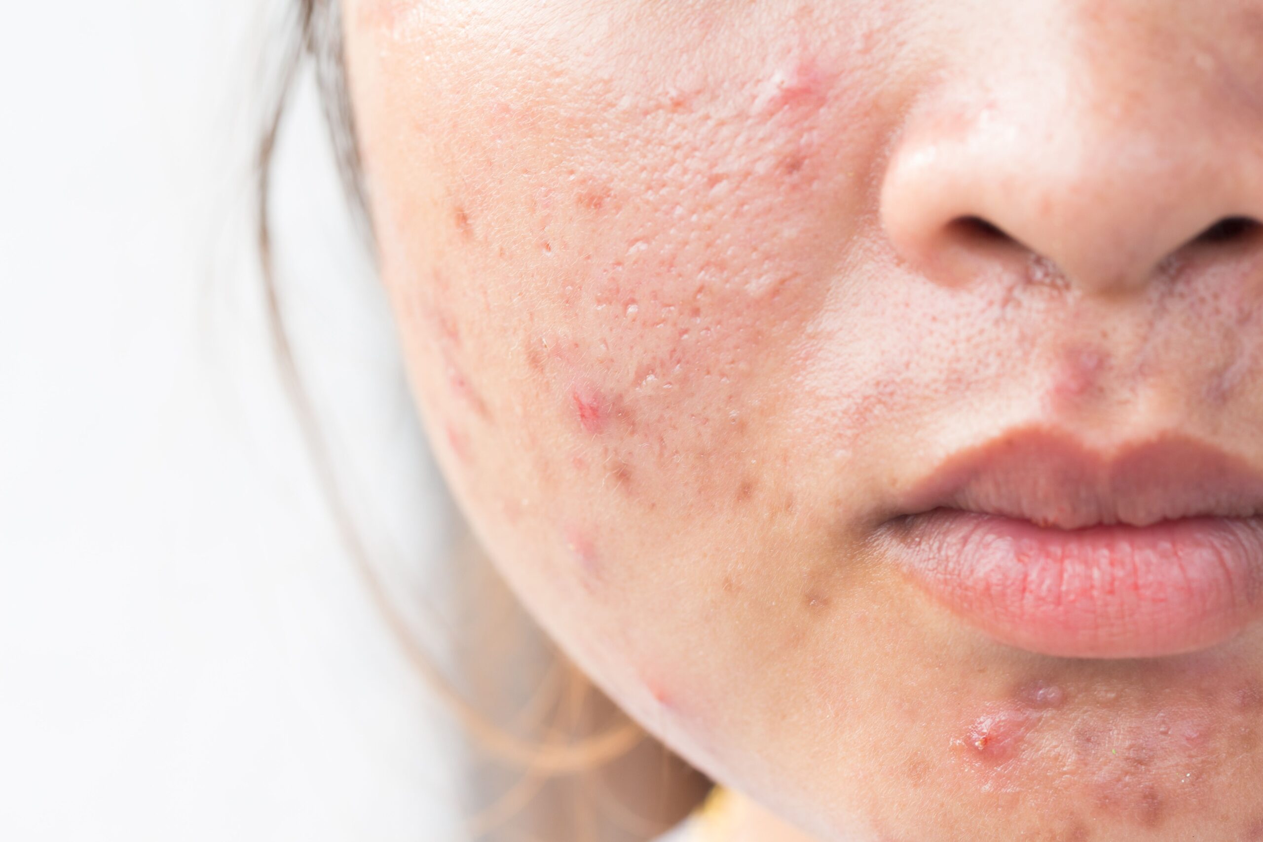 best skincare for oily skin