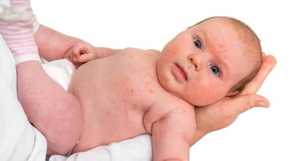 severe seasonal allergies treatment 