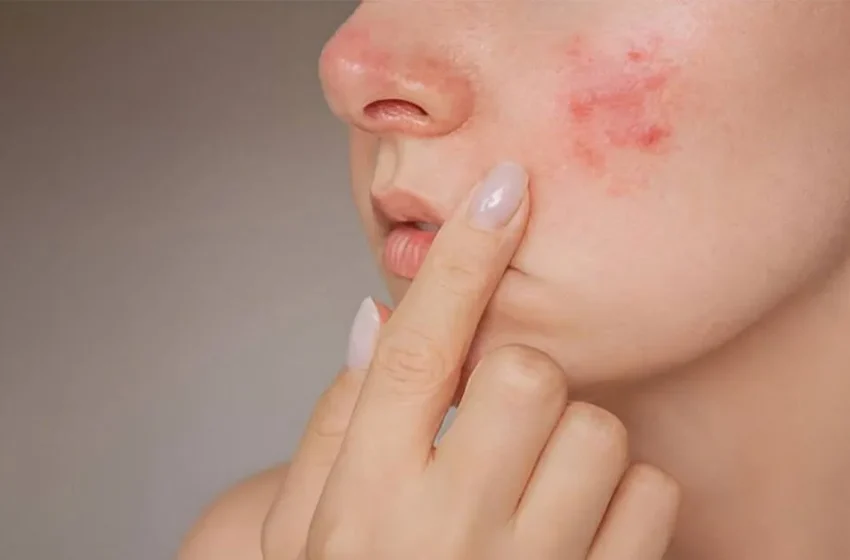 Does Creatine Cause Acne? Tips to Prevent Skin Breakouts