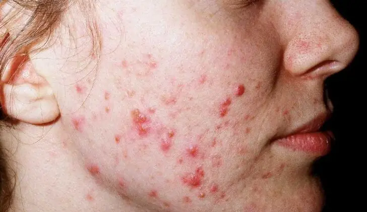 does creatine cause acne