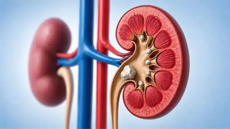 can creatine cause kidney stones
