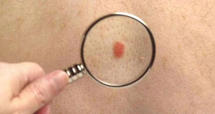  Early Signs of Nodular Melanoma You Should Never Ignore