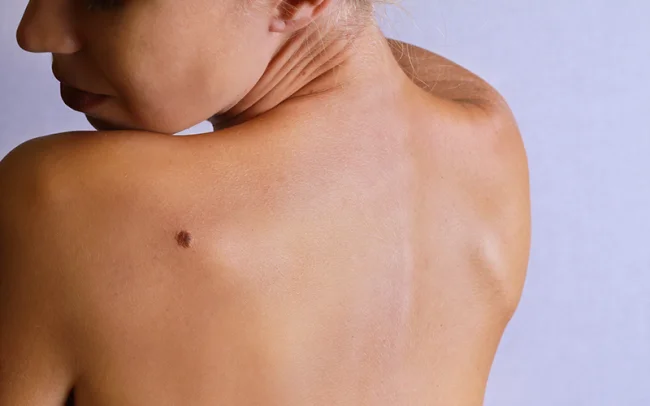 nodular melanoma