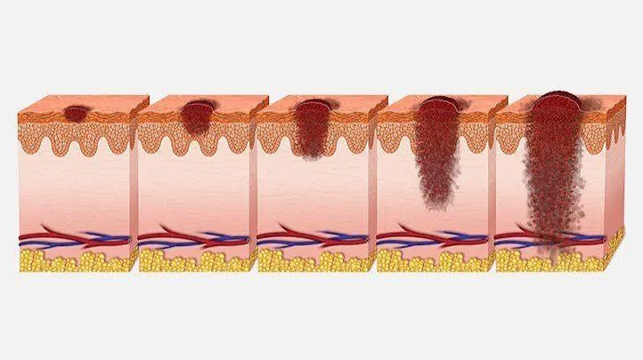 nodular melanoma