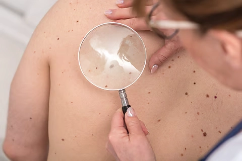 nodular melanoma