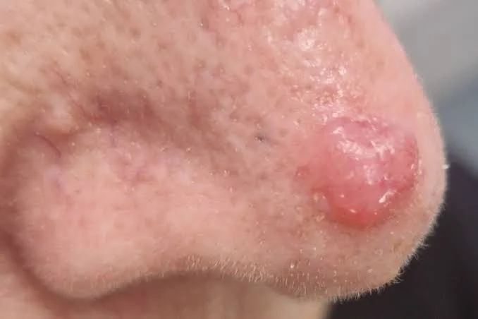  Risk Factors Associated with Amelanotic Melanoma Development
