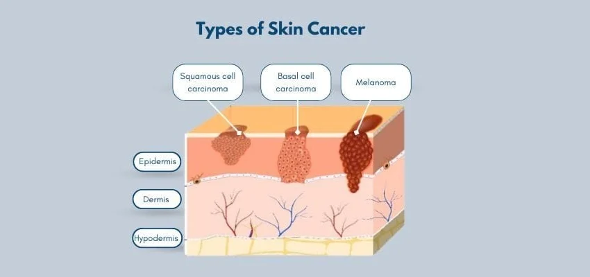  Understanding Melanoma Skin Cancer and Its Symptoms