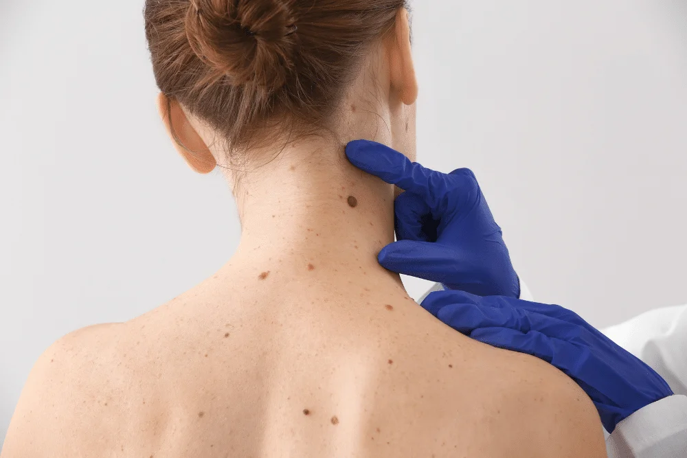 melanoma skin cancer