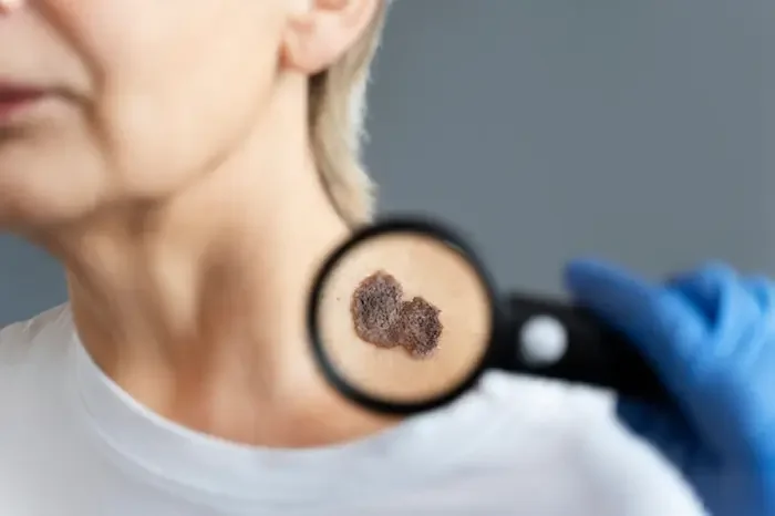 melanoma skin cancer