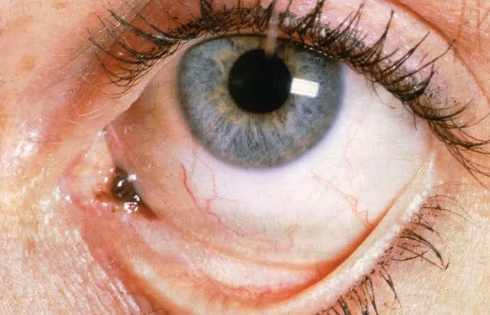  Understanding Ocular Melanoma: Symptoms and Early Signs