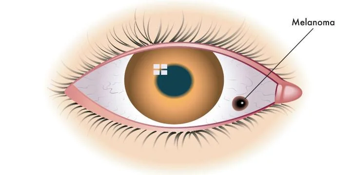 ocular melanoma