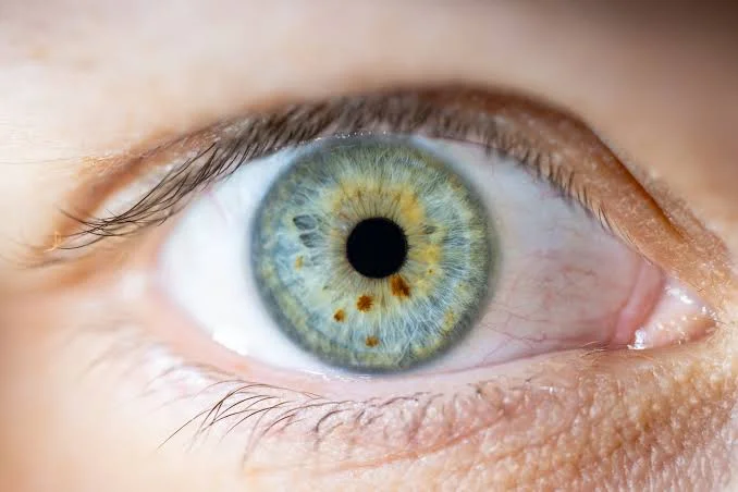 ocular melanoma