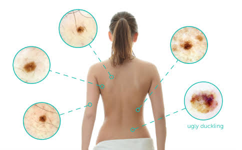amelanotic melanoma