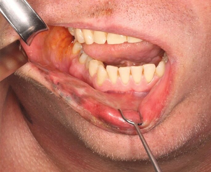  Mucosal Melanoma: Causes, Risks, and Prevention Strategies
