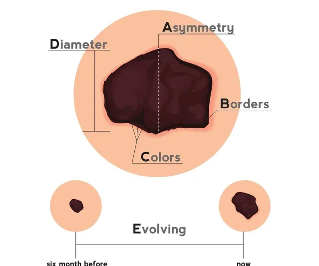 mucosal melanoma