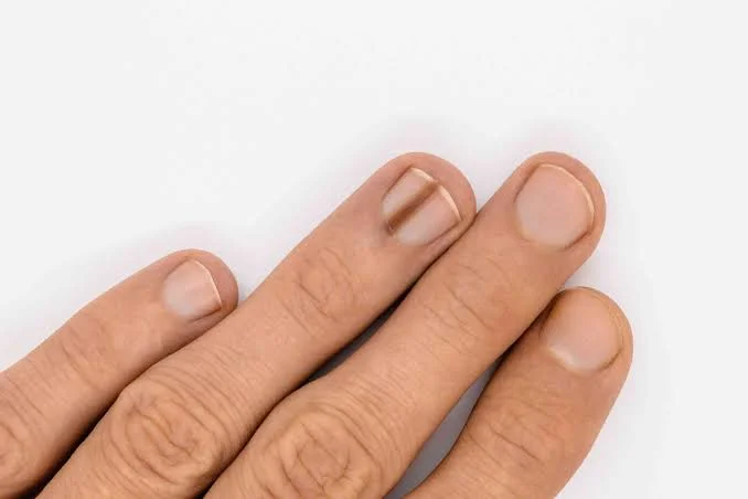 nail melanoma