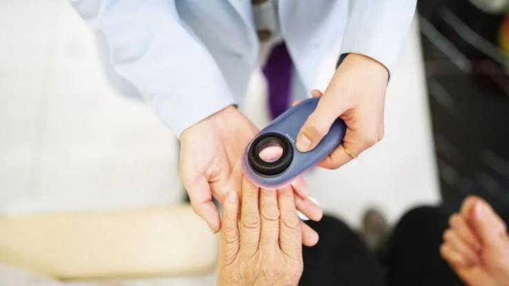 normal black line on nail vs melanoma