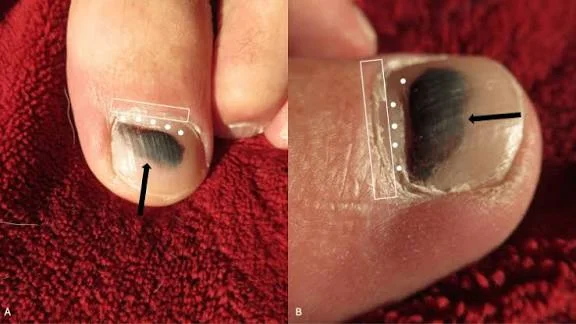 normal black line on nail vs melanoma