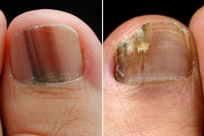  Nail Melanoma vs. Nail Fungus: Key Differences Explored
