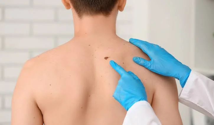 skin melanoma