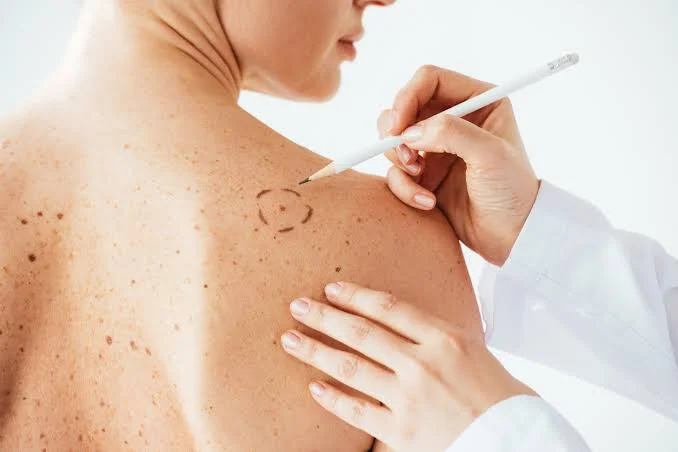  Signs of Melanoma: How to Spot Them Before It Spreads