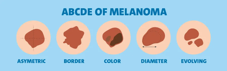 melanoma on scalp