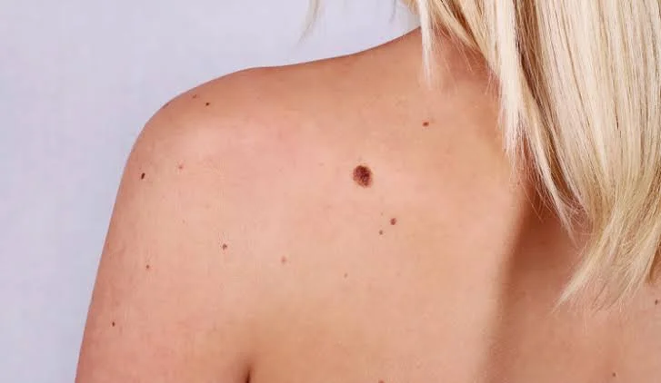 signs of melanoma